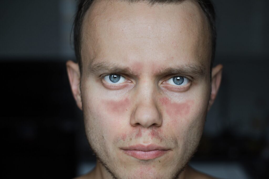 Young man with lupus shows butterfly rash on face.