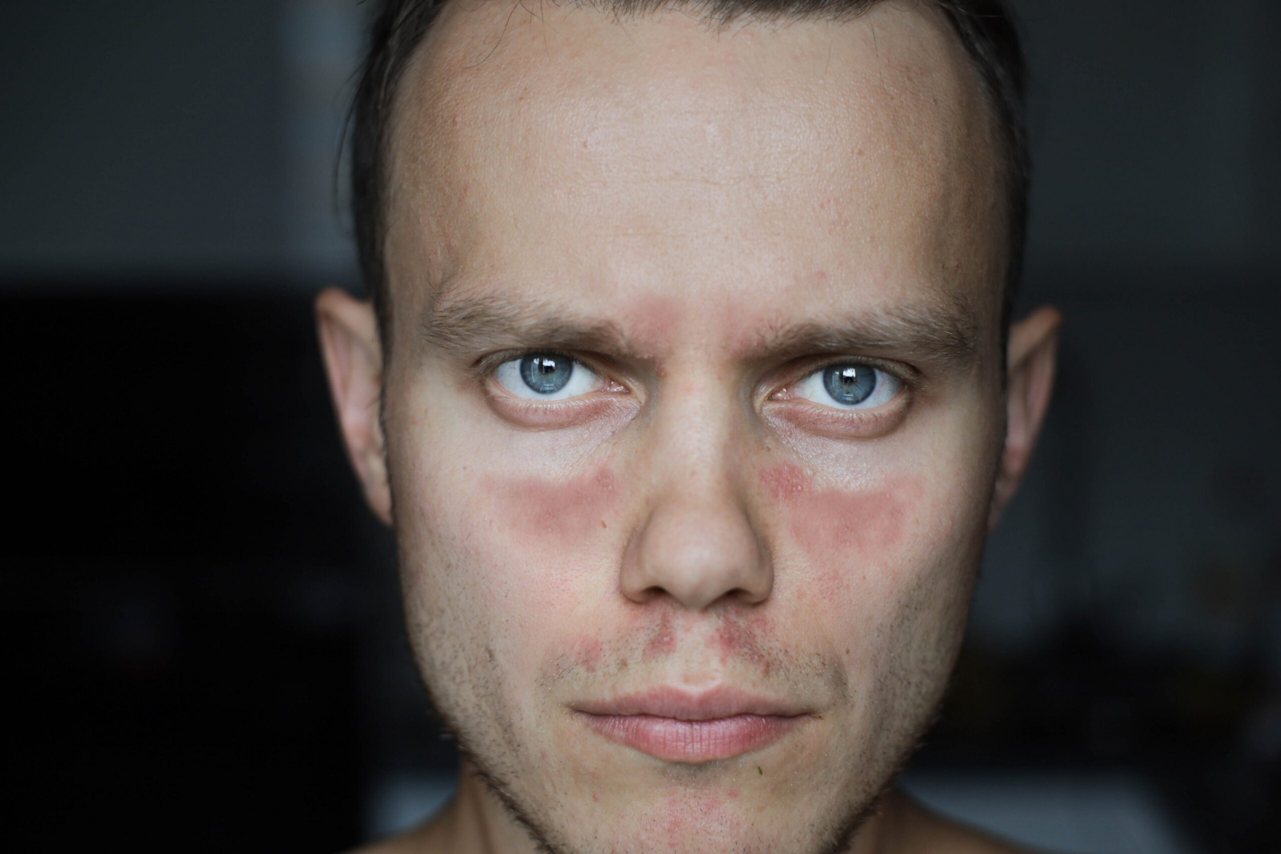 Young man with lupus shows butterfly rash on face.