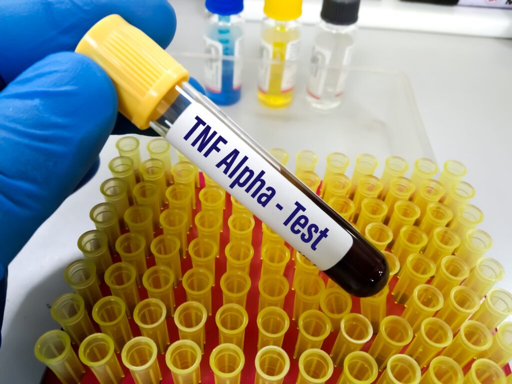 Doctor holding test tube labeled TNF Alpha - Test.