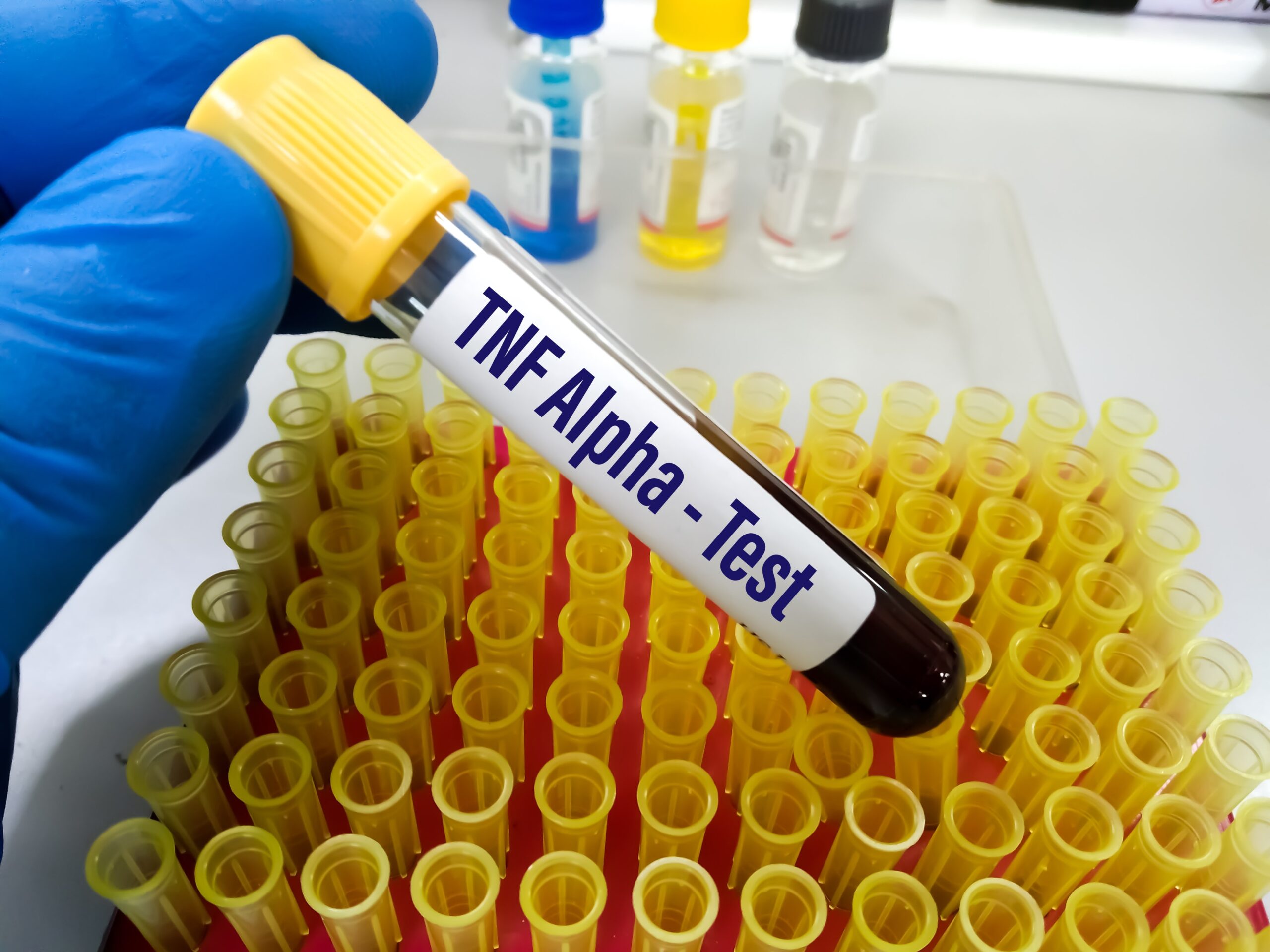 Doctor holding test tube labeled TNF Alpha - Test.